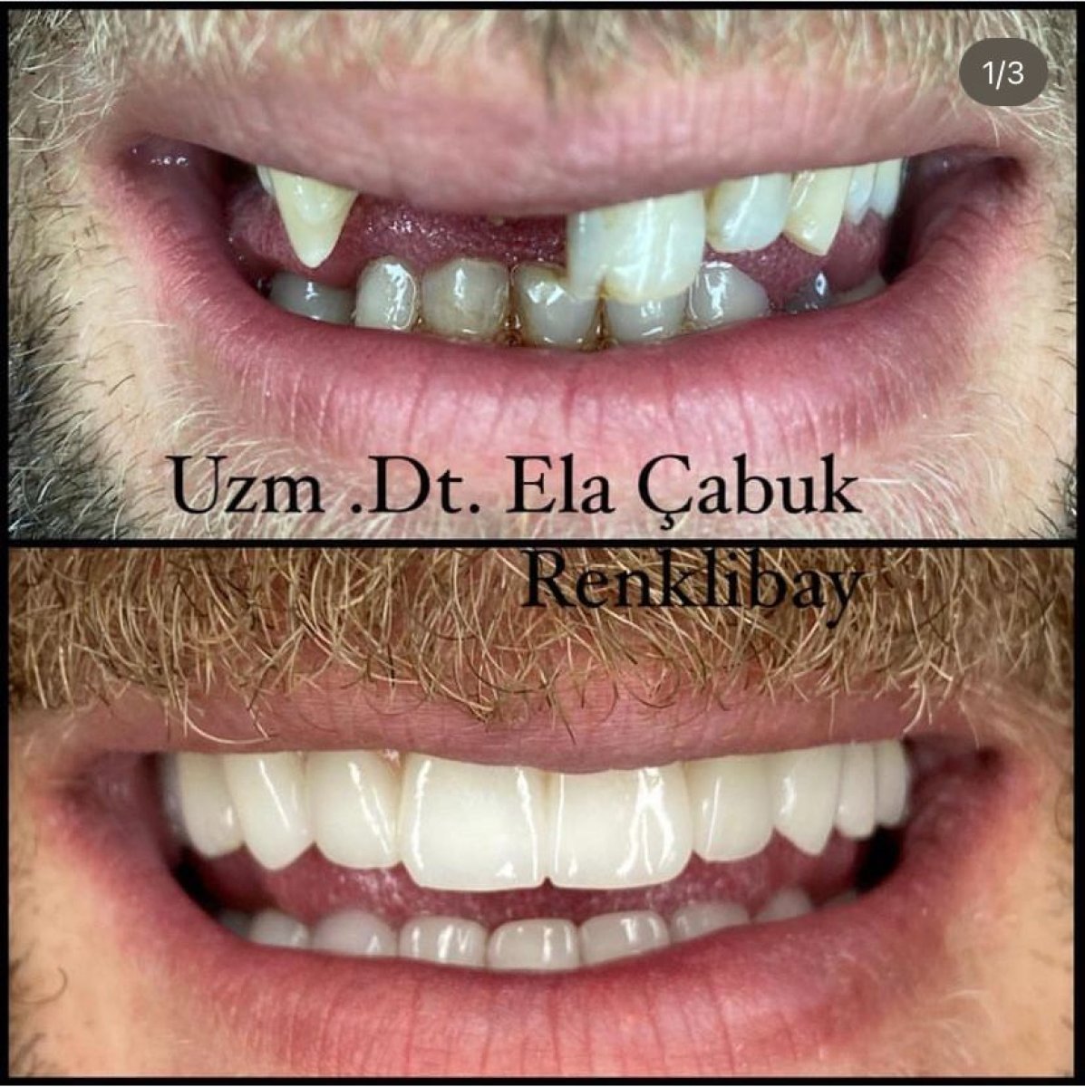 Résultats avant et après collage dentaire à la clinique privée Dr Ela Cabuk Renklibay