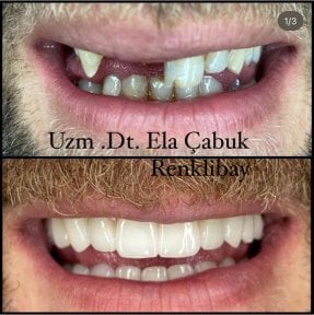 Résultats avant et après collage dentaire à la clinique privée Dr Ela Cabuk Renklibay
