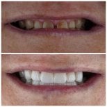 Resultados antes y después de implantes dentales en Nifa Dent International – sonrisa restaurada