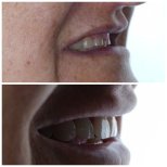 Before and after dental implant results at Nifa Dent International, improved smile aesthetics