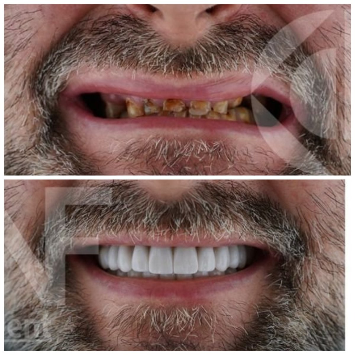 نتائج قبل وبعد زراعة الأسنان في Nifa Dent International، ابتسامة طبيعية مستعادة