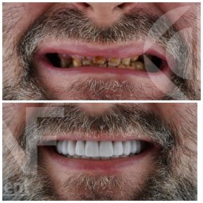Before and after dental implant results at Nifa Dent International, restored natural smile