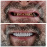 Before and after dental implant results at Nifa Dent International, restored natural smile