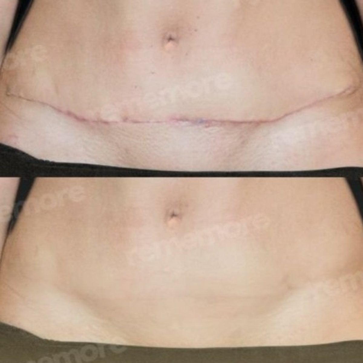 Resultados de revisión de cicatriz antes y después en Memorial Şişli Hospital, abdomen mejorado