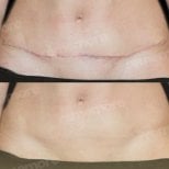 Scar revision before and after results at Memorial Şişli Hospital, improved abdominal scar