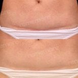 Before and after scar revision results on abdomen at Memorial Şişli Hospital