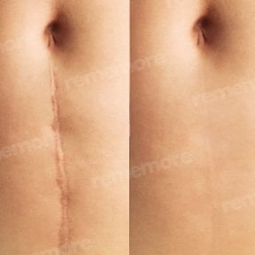 Scar revision before and after results at Memorial Şişli Hospital – improved abdominal skin