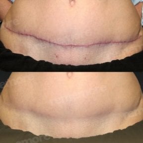 Before and after scar revision results at Memorial Şişli Hospital, improved abdominal scar