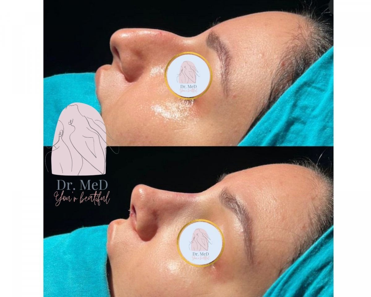 نتائج قبل وبعد تجميل طرف الأنف في Dr. MED، إعادة تشكيل الأنف بشكل طبيعي