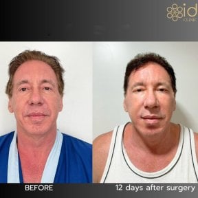 Facelift before and after results at ID Clinic Bangkok, visible facial rejuvenation in 12 days