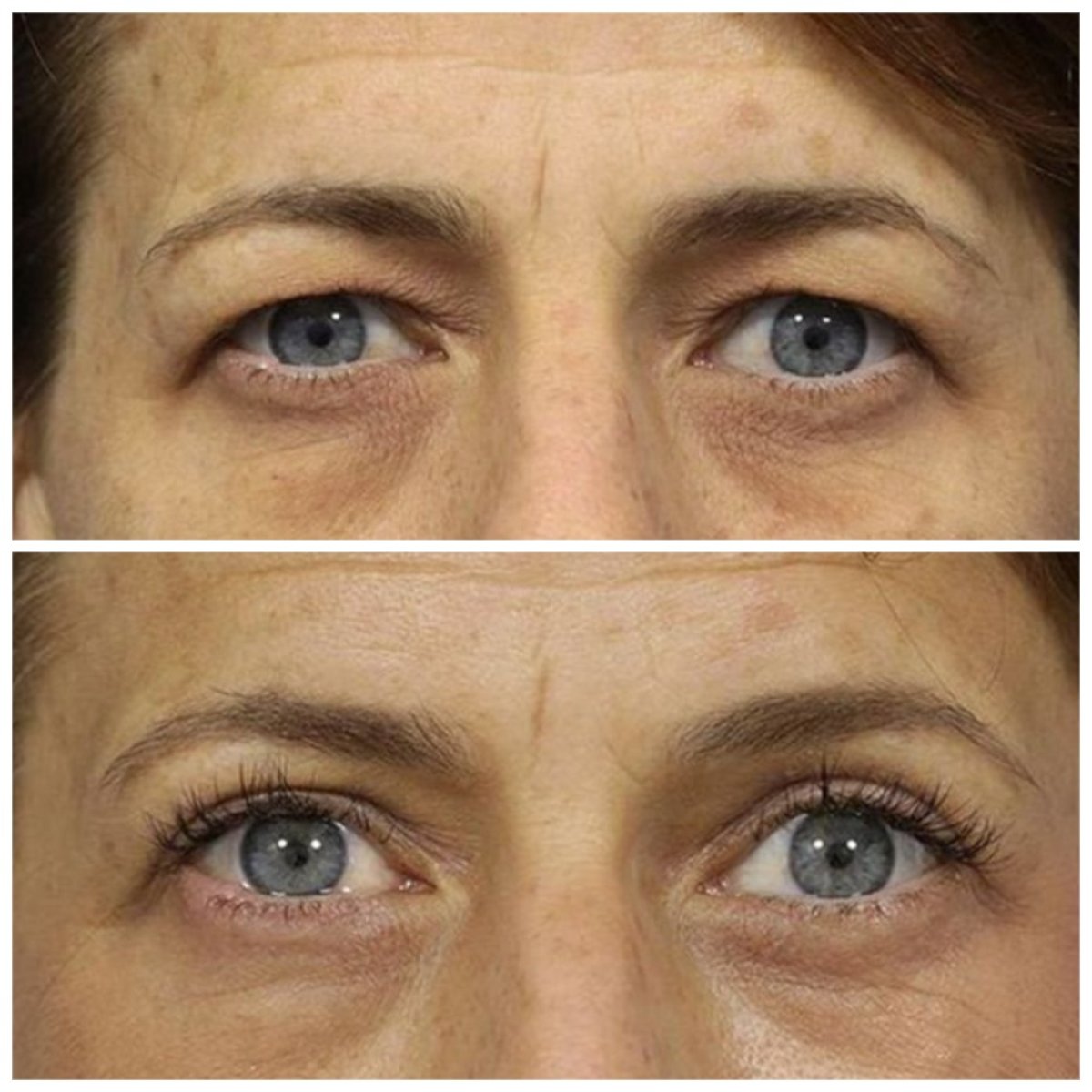 Before and after blepharoplasty results at TWT Health Clinic, eyelid correction improvement