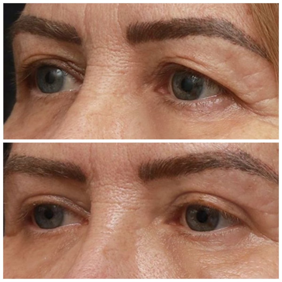 Before and after blepharoplasty results at TWT Health Clinic, eyelid correction improvement