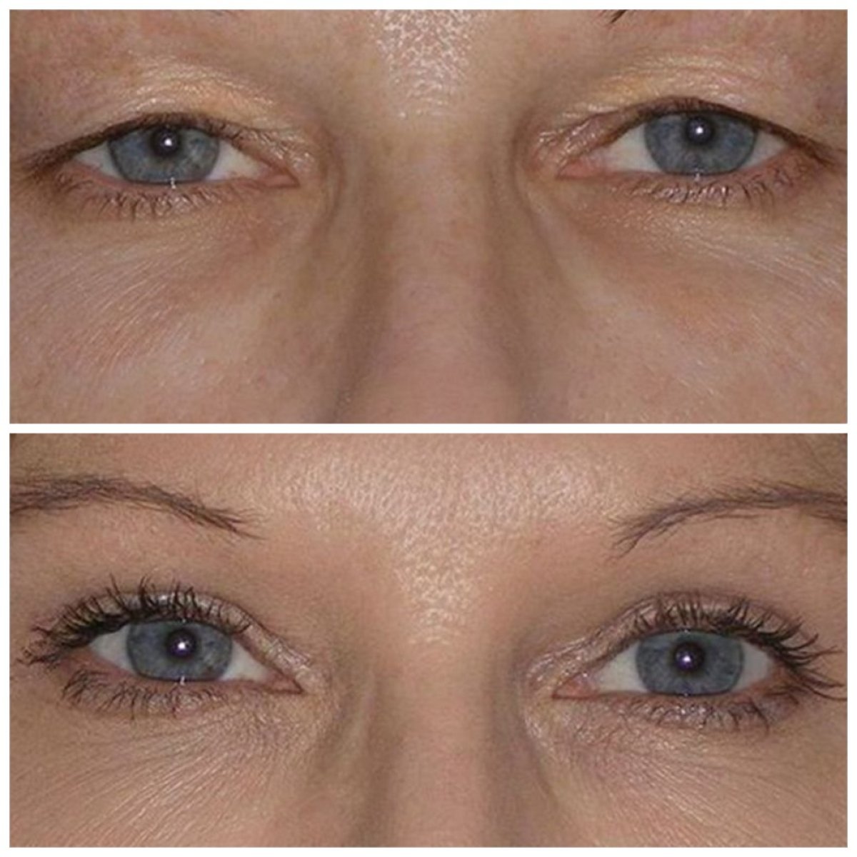 Before and after blepharoplasty results at TWT Health Clinic, eyelid correction improvement