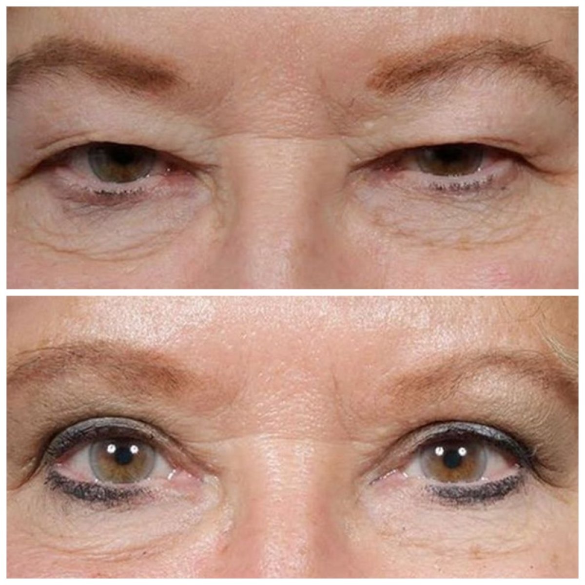 Before and after blepharoplasty results at TWT Health Clinic, eyelid correction improvement