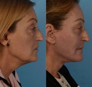 Facelift Vorher-Nachher-Ergebnisse in der Private Yüzyıl Hospital, sichtbare Verjüngung