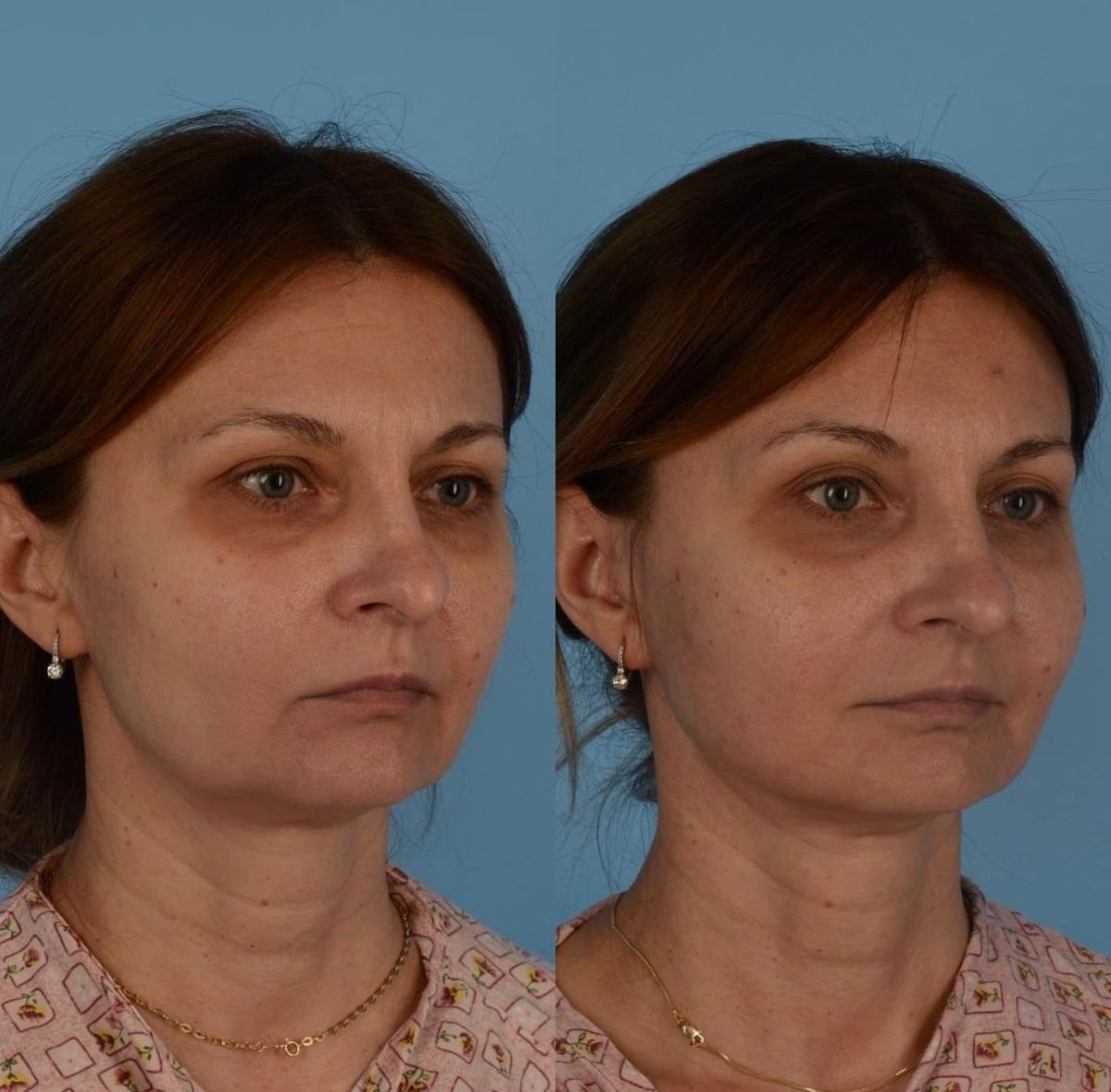 Результаты до и после подтяжки лица в Private Yüzyıl Hospital, видимое омоложение