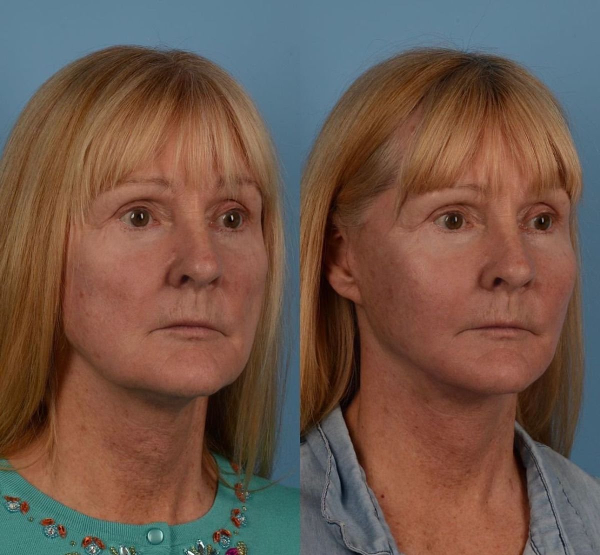 Результаты до и после подтяжки лица в Private Yüzyıl Hospital, видимое омоложение лица