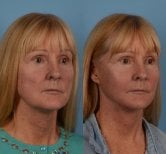 Результати підтяжки обличчя до і після в Private Yüzyıl Hospital, помітне омолодження