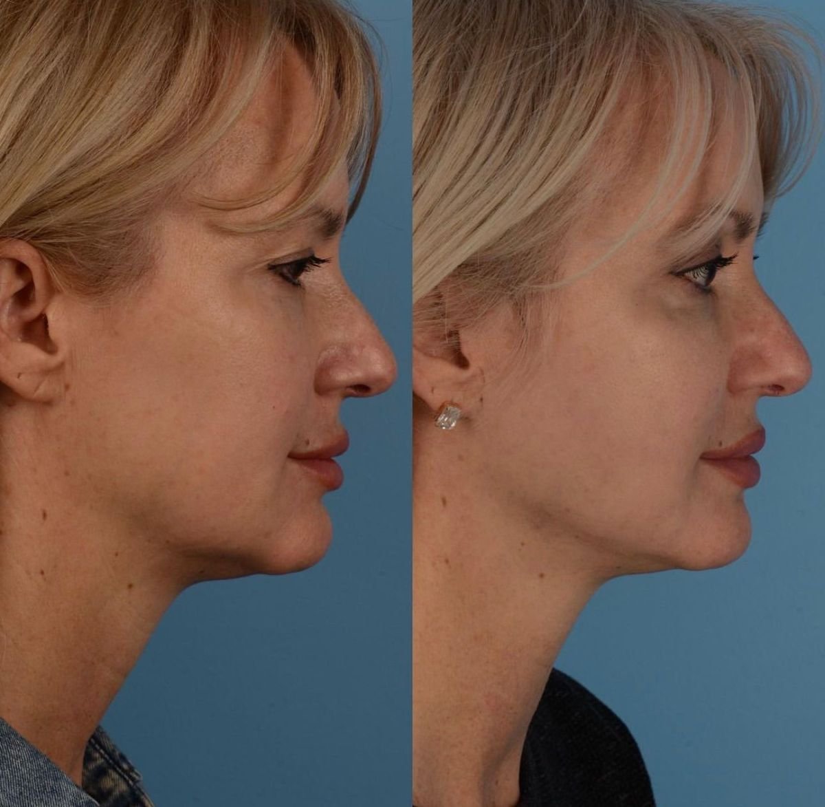 Результаты до и после подтяжки лица в Private Yüzyıl Hospital – четкая линия подбородка