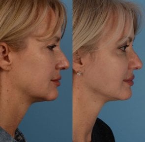 Результати до і після підтяжки обличчя в Private Yüzyıl Hospital – чітка лінія підборіддя