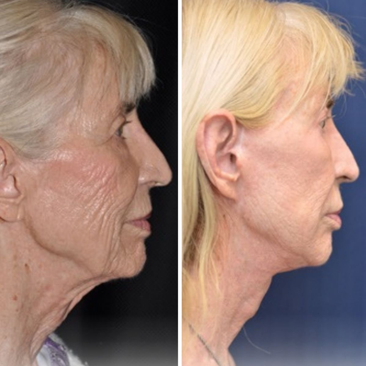 Результаты до и после подтяжки лица в Private Yüzyıl Hospital, видимое омоложение