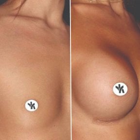 Vorher-nachher-Ergebnis Brustimplantat-Revision in der Private Yüzyıl Hospital, verbesserte Form