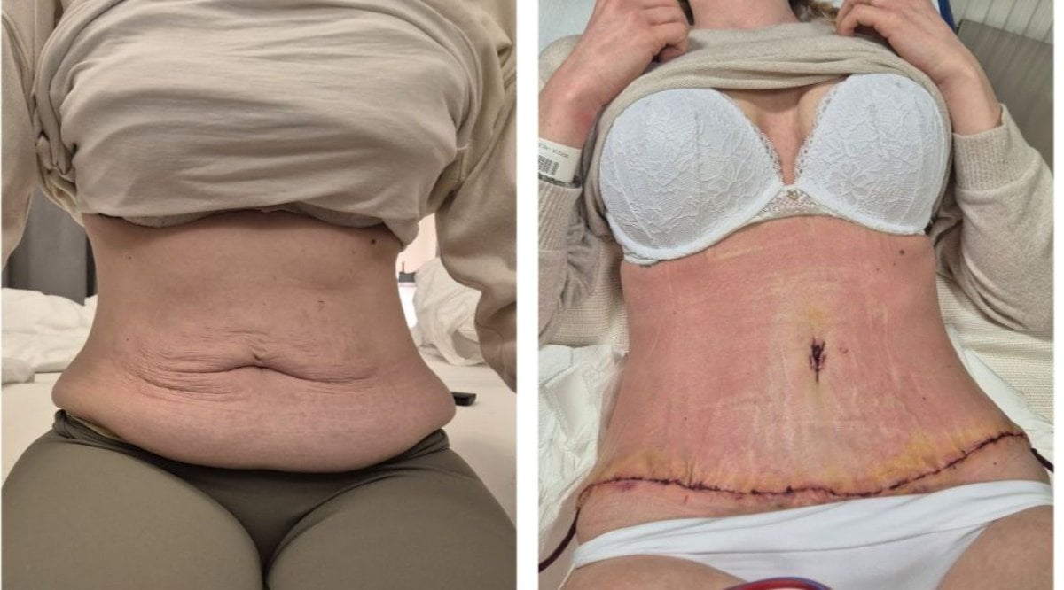 Before and after abdominal liposuction results at KCM Clinic showing flatter, contoured waist
