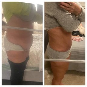 Résultats avant et après liposuccion abdominale à KCM Clinic, amélioration visible du contour