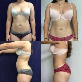 360 liposuction before and after results at Marroquín & Sandoval Plastic Surgery Clinic