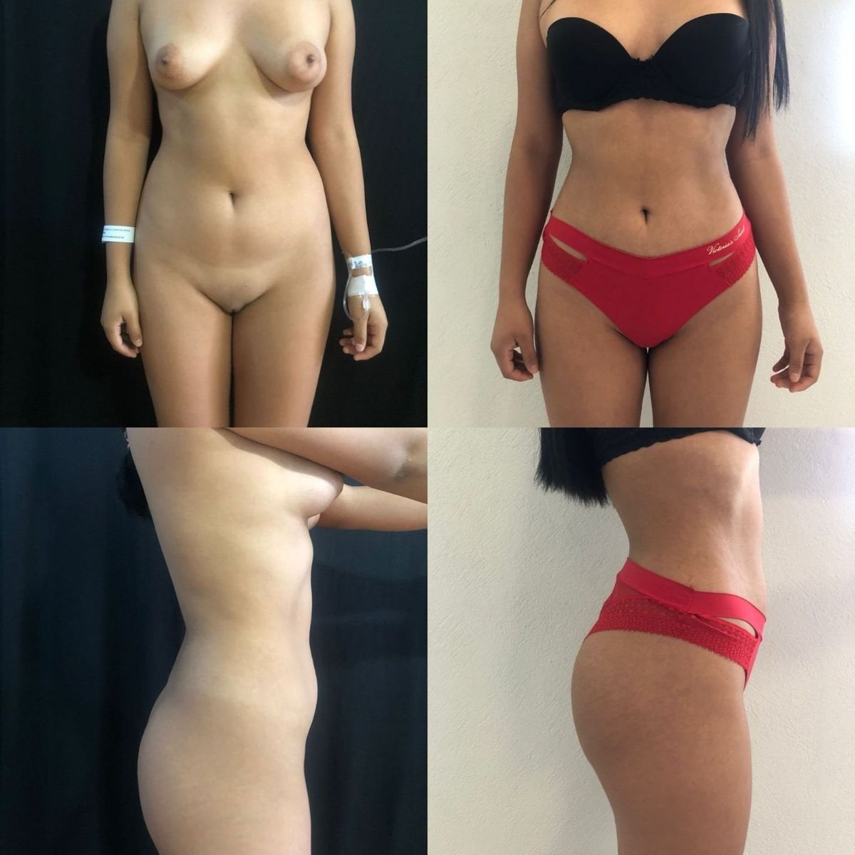 Resultados de antes y después de lipoescultura 360 en Marroquín & Sandoval Plastic Surgery Clinic