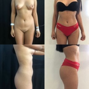 Before and after 360 liposuction results at Marroquín & Sandoval Plastic Surgery Clinic