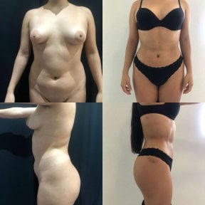 Before and after 360 liposuction results at Marroquín & Sandoval Plastic Surgery Clinic