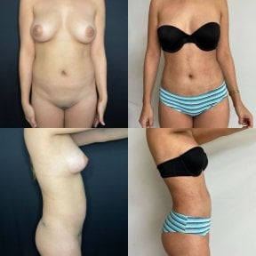 Before and after 360 liposuction results at Marroquín & Sandoval Plastic Surgery Clinic