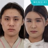 Before and after lipofilling results at Wansiri Hospital – facial volume and skin improvement