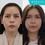 Результати ліпофілінгу до і після у Wansiri Hospital – покращення об'єму та контуру обличчя