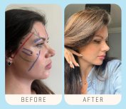 Resultados de rinoplastia antes y después en Estexper Clinic, mejor forma y perfil nasal