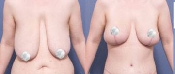 Before and after breast reduction results at ID Clinic Bangkok, improved breast shape and lift