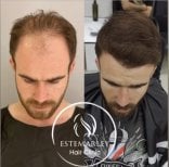 Before and after hair transplant results at Estemarley – restored hairline and fuller hair