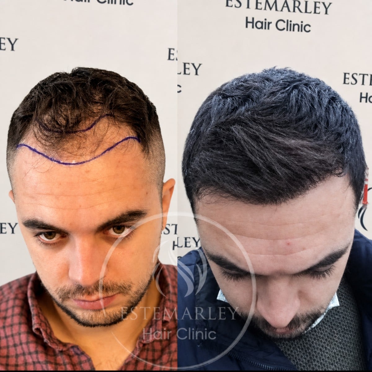 نتائج زراعة الشعر قبل وبعد في عيادة Estemarley – خط شعر مستعاد وكثافة أكبر