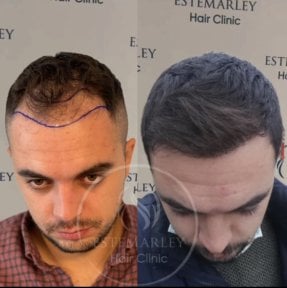 Before and after hair transplant results at Estemarley – restored hairline and fuller hair
