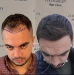 Before and after hair transplant results at Estemarley – restored hairline and fuller hair