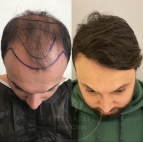 Before and after hair transplant results at Estemarley – restored hairline and fuller hair