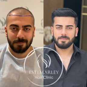 Vorher-nachher-Ergebnis Haartransplantation bei Estemarley – Haaransatz wiederhergestellt