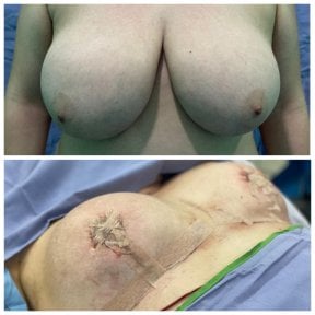 Before and after breast reduction results at Hospital Jardines, visible size and shape change