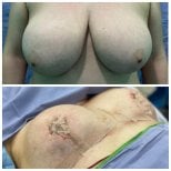 Before and after breast reduction results at Hospital Jardines, visible size and shape change