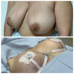 Before and after breast reduction results at Hospital Jardines, visible size and shape improvement