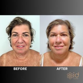 Before and after deep plane facelift results at ID Clinic Bangkok, visible facial rejuvenation
