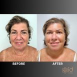 Before and after deep plane facelift results at ID Clinic Bangkok, visible facial rejuvenation