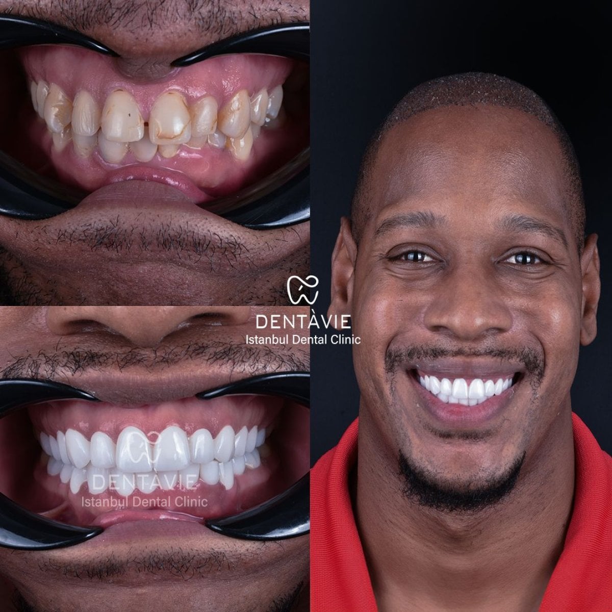 نتائج قبل وبعد ابتسامة هوليود في Dentavie Istanbul Dental Clinic، تغيير الابتسامة