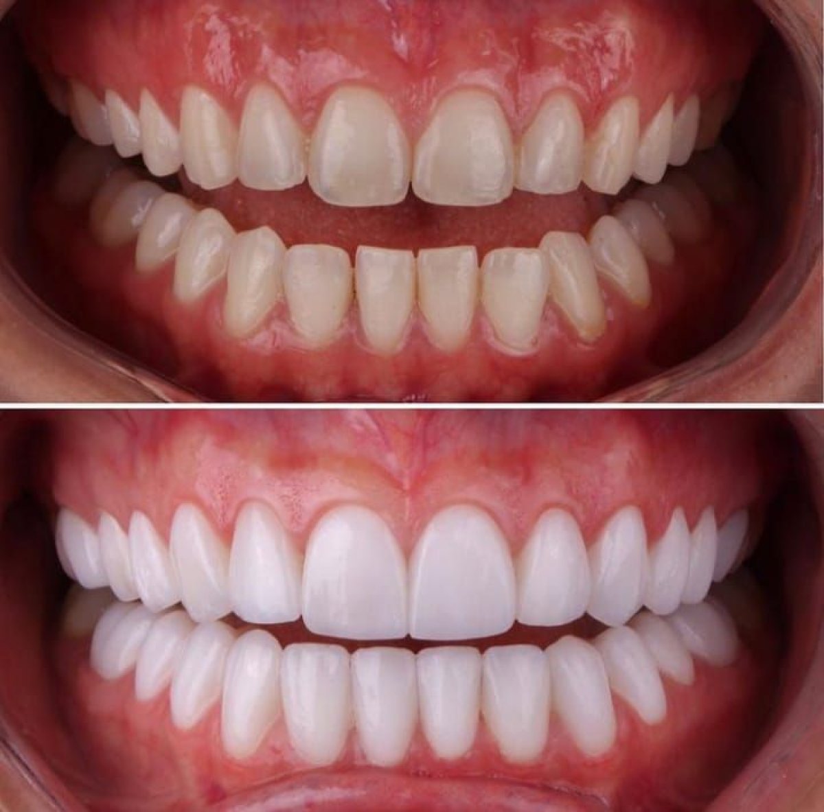 Antes y después de carillas Hollywood Smile en Dentavie Istanbul Dental Clinic, resultado sonrisa